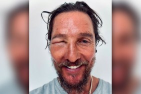 Matthew McConaughey Bee Sting Eye